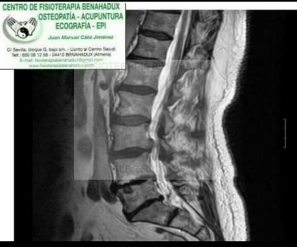 Estenosis foraminal en fisioterapia