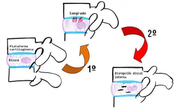 ¿PERO A MI COMO SE ME HA HECHO UNA HERNIA DE DISCO?