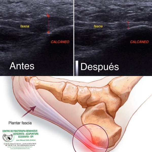 BUENOS RESULTADO EN FASCITIS PLANTAR