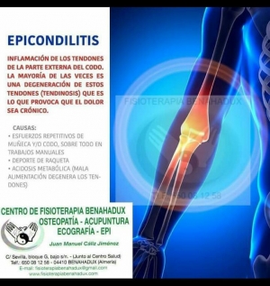 Epicondilitis en fisioterapia