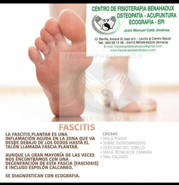 Fascitis plantar