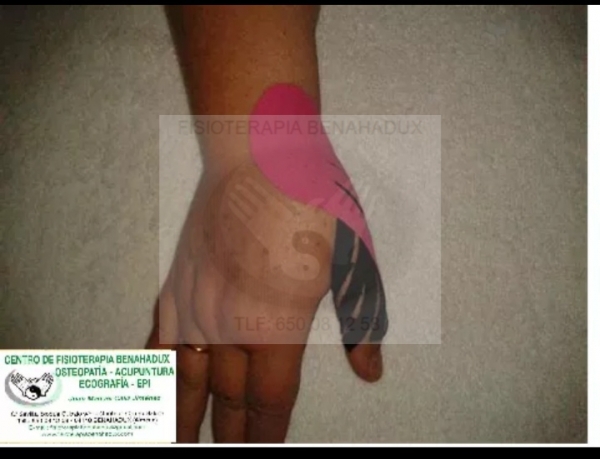 Rizartrosis y tendinitis de d&#039;quervain