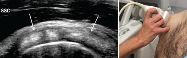 LESION DEL HOMBRO EN FISIOTERAPIA AVANZADA