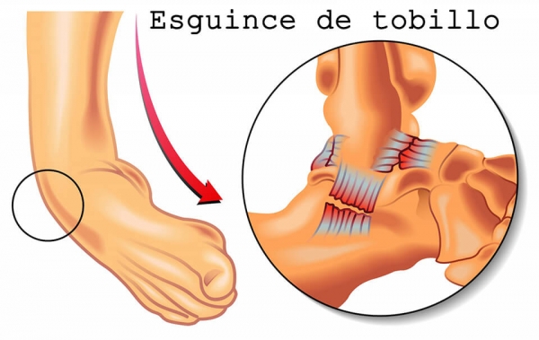 Porqué no se debe inmovilizar un esguince de tobillo