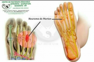 Neuroma morton