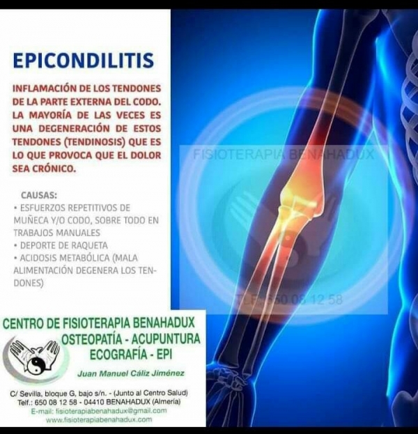 Infografía epicondilitis